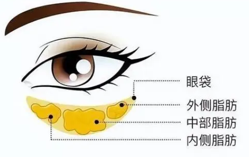 去眼袋手术