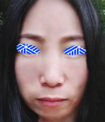 去眼袋手术