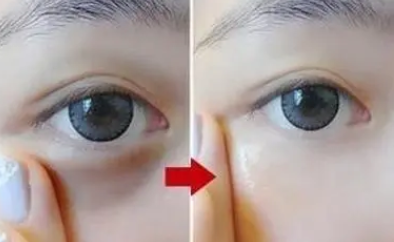 去眼袋手术