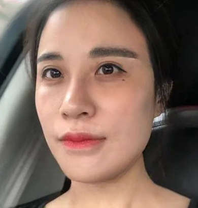 去眼袋手术