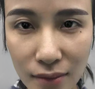 去眼袋手术