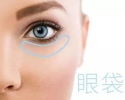 去眼袋手术