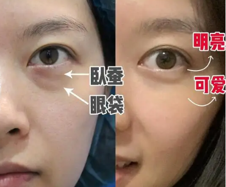 去眼袋手术