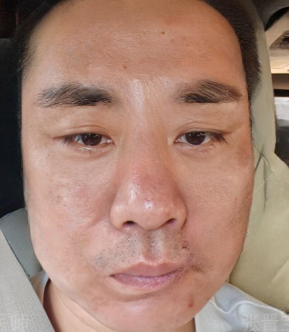 去眼袋手术
