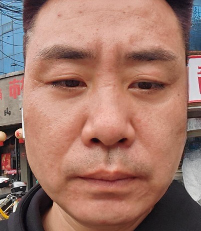 去眼袋手术