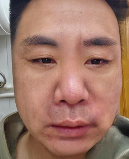 去眼袋手术