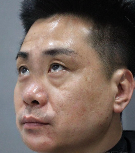 去眼袋手术