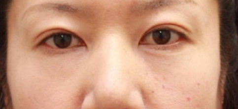 眼袋手术