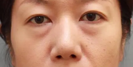 眼袋手术