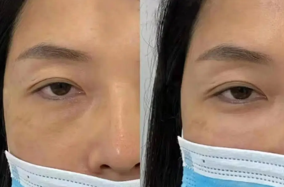 眼袋手术
