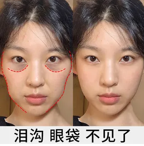 眼袋手术