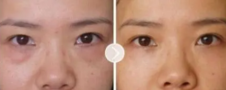 眼袋手术