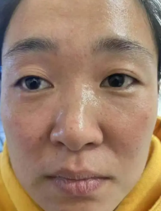 眼袋