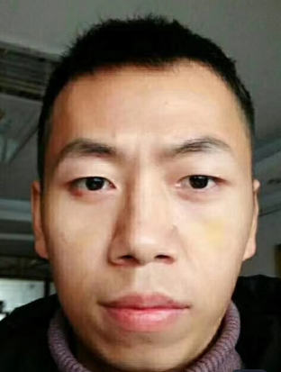 去眼袋手术
