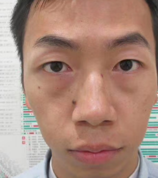去眼袋手术