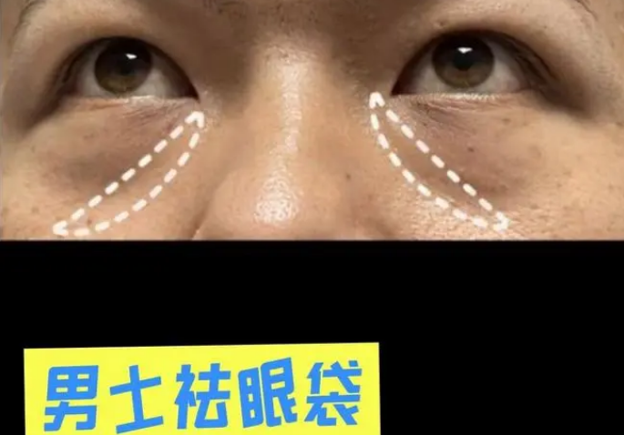 去眼袋手术