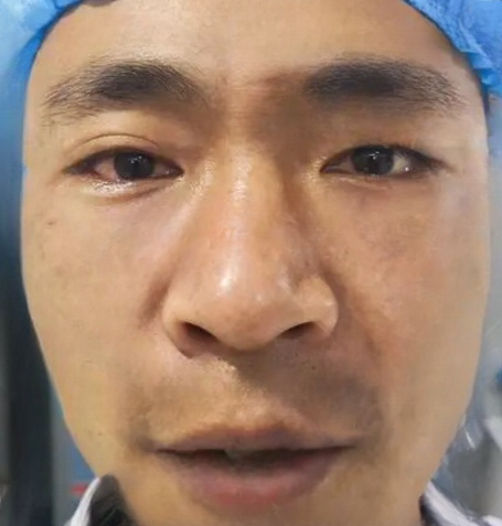 去眼袋手术