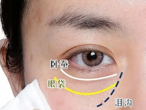 去眼袋手术