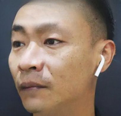 去眼袋手术