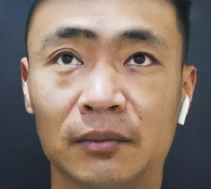 去眼袋手术