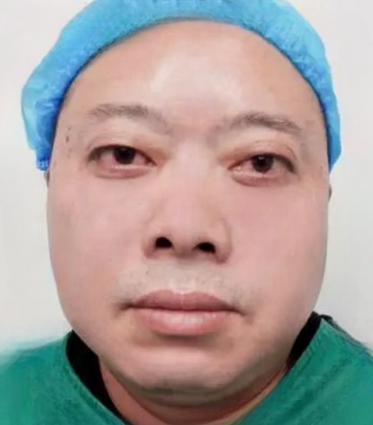去眼袋手术