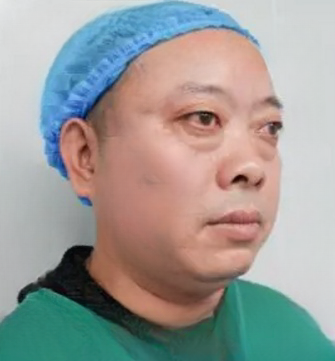 去眼袋手术