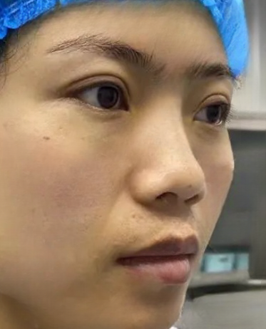 去眼袋手术
