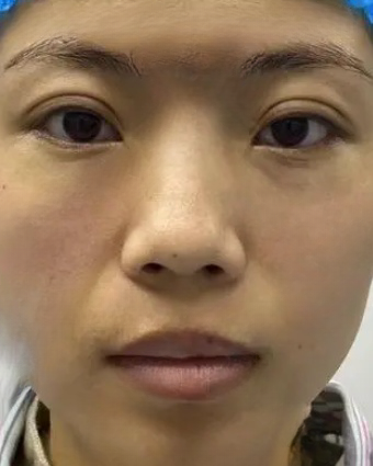 去眼袋手术
