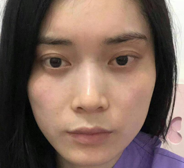 去眼袋手术