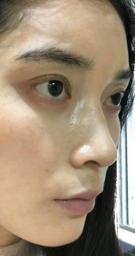 去眼袋手术