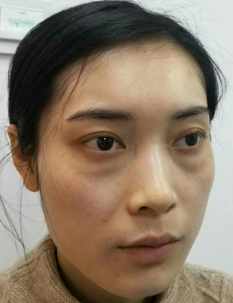 去眼袋手术