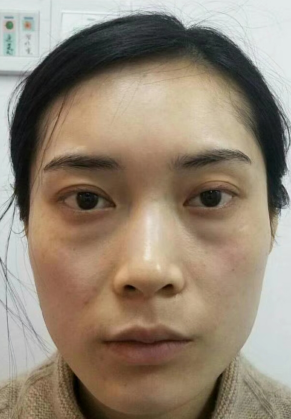 去眼袋手术