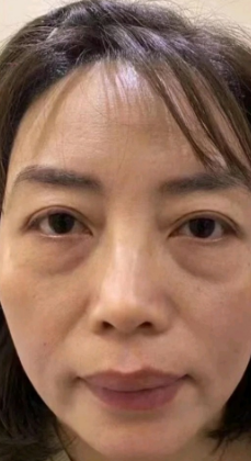 去眼袋手术