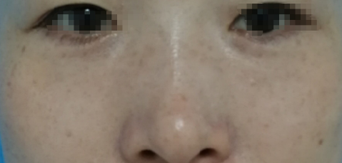去眼袋手术