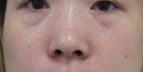 去眼袋手术