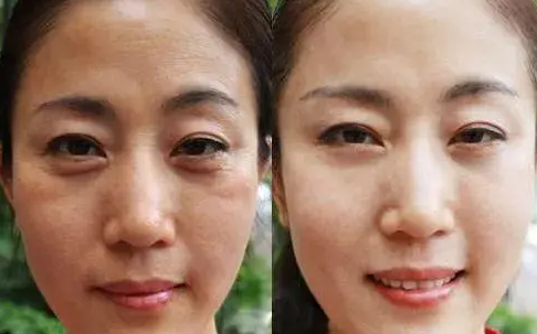 去眼袋手术