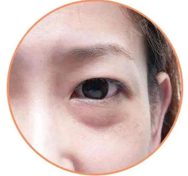 去眼袋手术