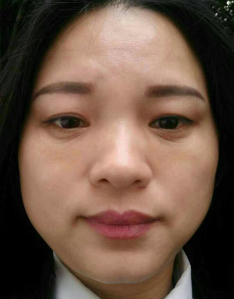 去眼袋手术