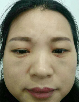 去眼袋手术
