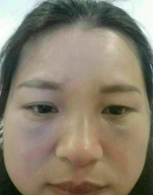 去眼袋手术