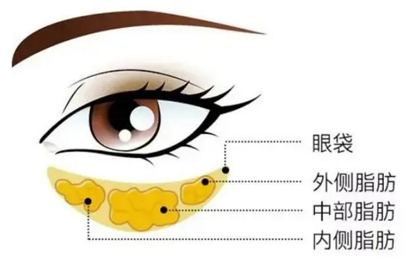 去眼袋手术