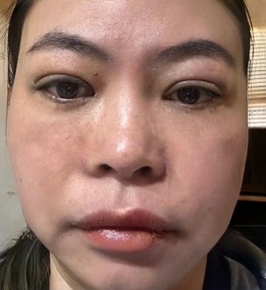 去眼袋手术