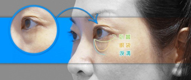 去眼袋手术