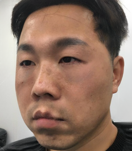 去眼袋手术