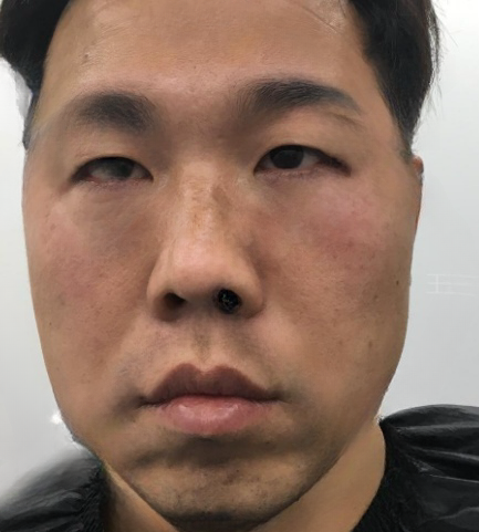 去眼袋手术