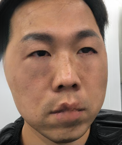 去眼袋手术