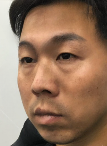 去眼袋手术