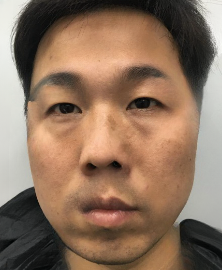 去眼袋手术