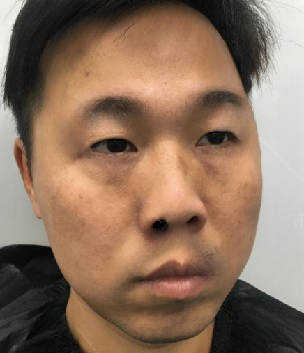 去眼袋手术