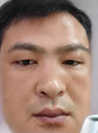 去眼袋手术